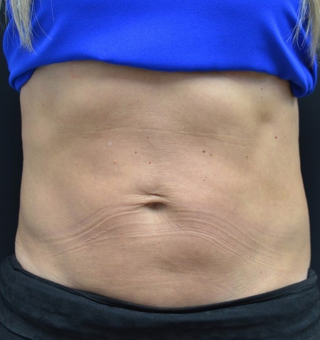 After Image: Abdomen - front