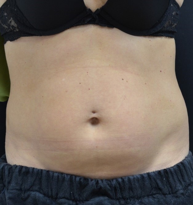 Before Image: Abdomen - front
