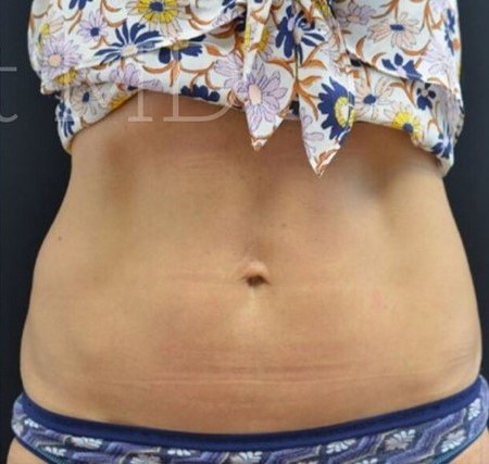After Image: Abdomen - front
