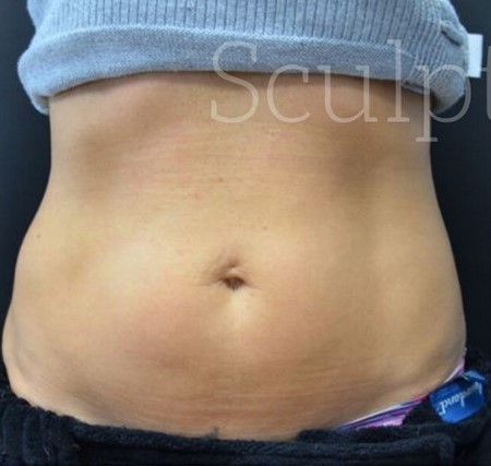 Before Image: Abdomen - front