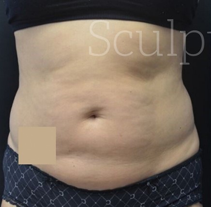 Before Image: Abdomen - front