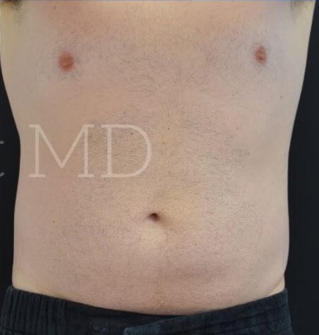 After Image: Abdomen - front