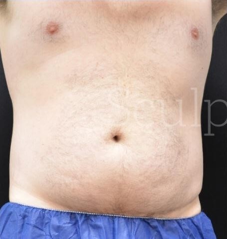 Before Image: Abdomen - front