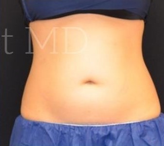 After Image: Abdomen - front