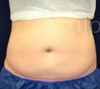 Before Image: Abdomen - front