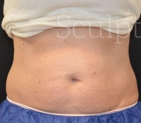 Before Image: Abdomen - front