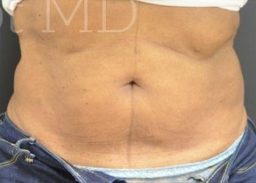 After Image: Abdomen - front