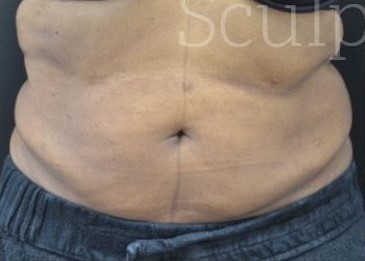 Before Image: Abdomen - front