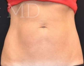 After Image: Abdomen - front