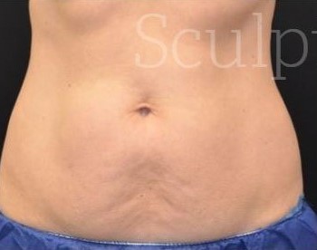 Before Image: Abdomen - front