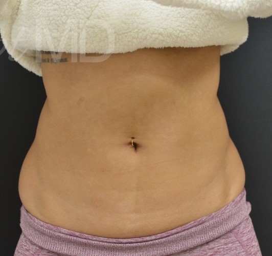 After Image: Abdomen - front