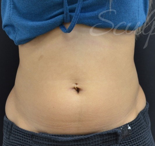 Before Image: Abdomen - front