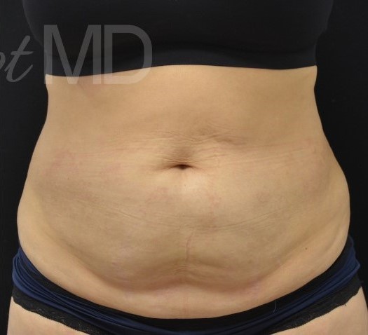 After Image: Abdomen - front