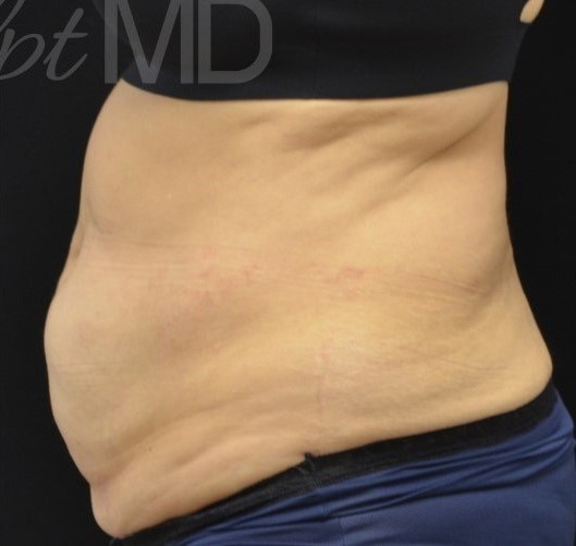 After Image: Abdomen - left-side