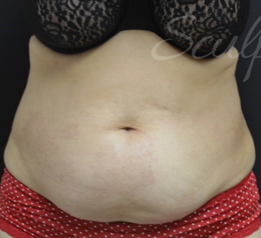 Before Image: Abdomen - front