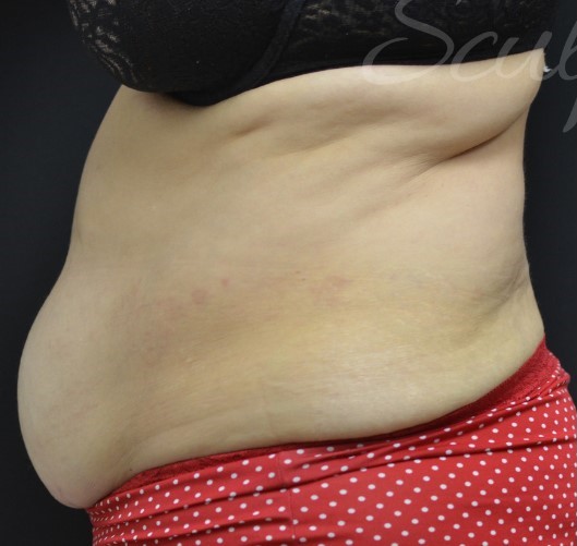 Before Image: Abdomen - left-side