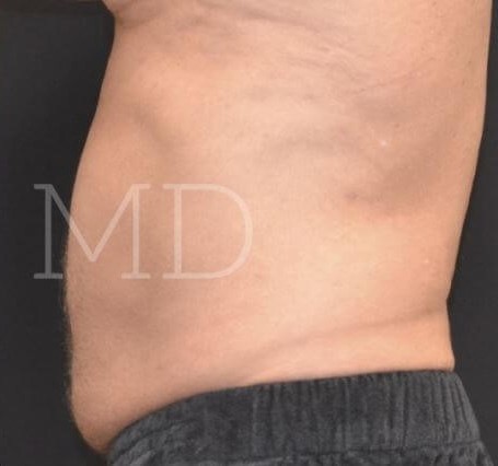After Image: Abdomen - left-side
