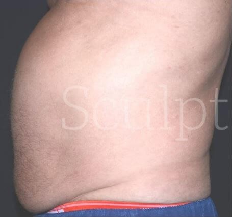 Before Image: Abdomen - left-side