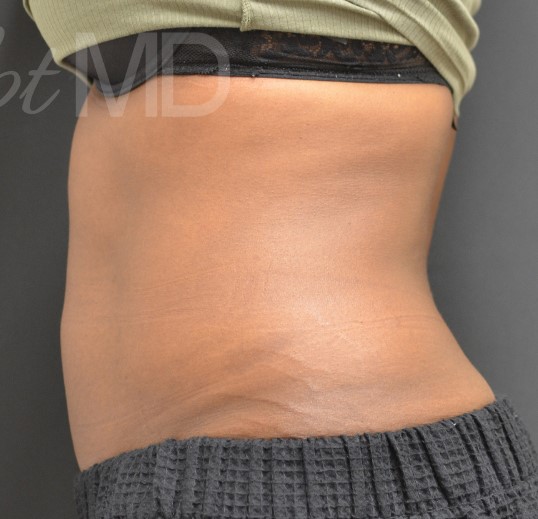 After Image: Abdomen - left-side