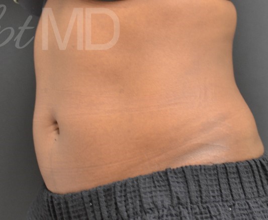 After Image: Abdomen - left-front-oblique