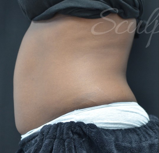 Before Image: Abdomen - left-side
