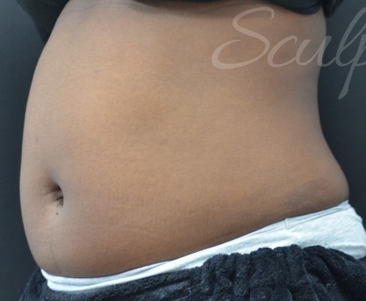 Before Image: Abdomen - left-front-oblique