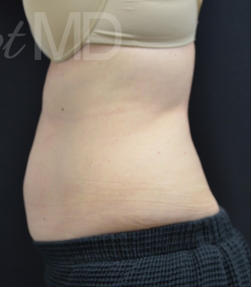 After Image: Abdomen - left-side