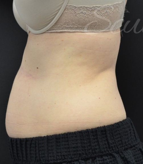 Before Image: Abdomen - left-side