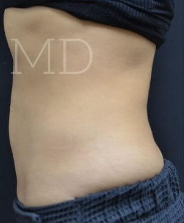 After Image: Abdomen - left-side