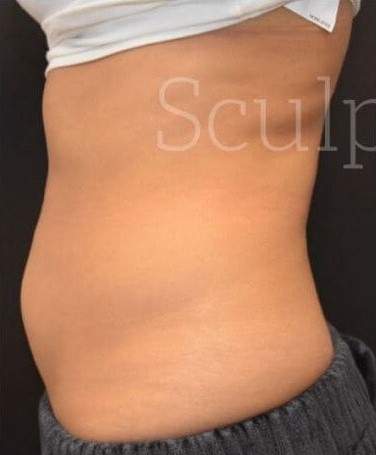 Before Image: Abdomen - left-side