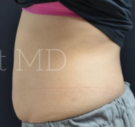 After Image: Abdomen - left-side