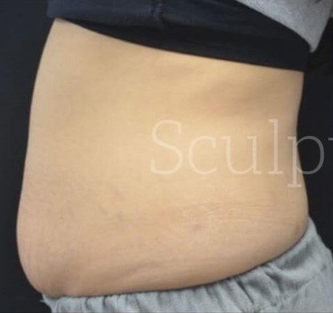 Before Image: Abdomen - left-side