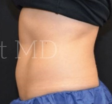 After Image: Abdomen - left-side