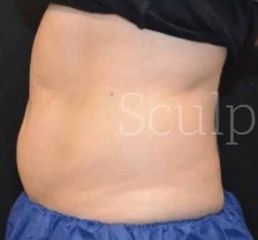 Before Image: Abdomen - left-side
