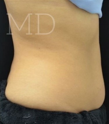 After Image: Abdomen - right-side