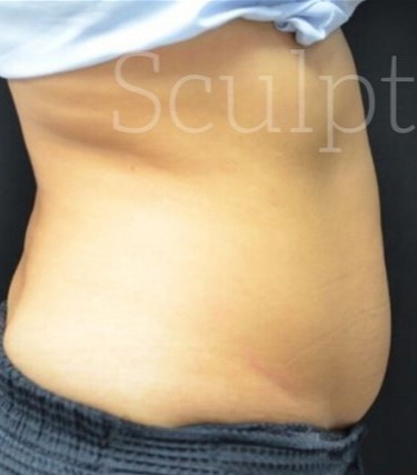Before Image: Abdomen - right-side