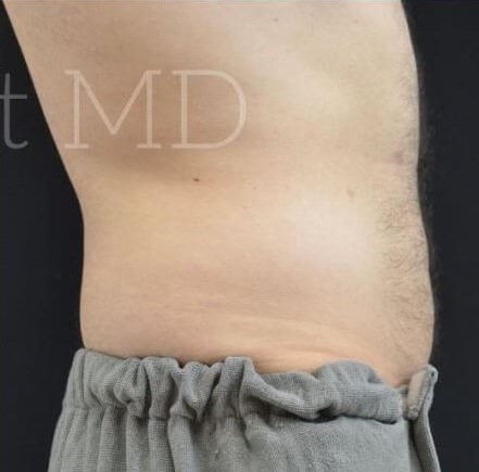 After Image: Abdomen - right-side