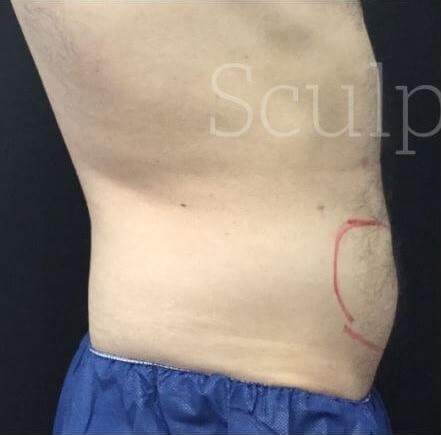 Before Image: Abdomen - right-side