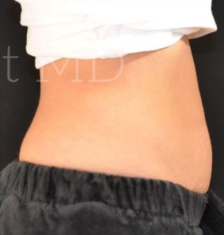 After Image: Abdomen - right-side