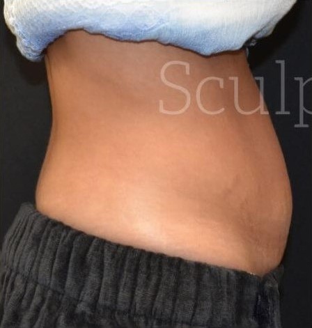 Before Image: Abdomen - right-side