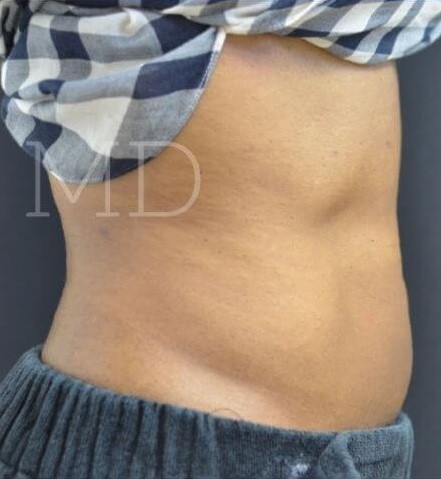 After Image: Abdomen - right-side