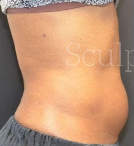 Before Image: Abdomen - right-side