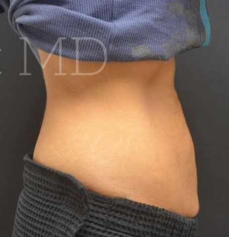 After Image: Abdomen - right-side