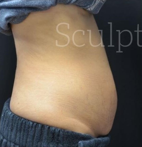 Before Image: Abdomen - right-side