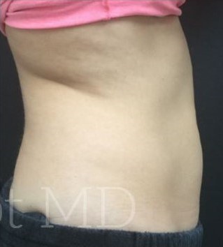 After Image: Abdomen - right-side