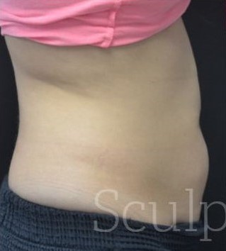 Before Image: Abdomen - right-side