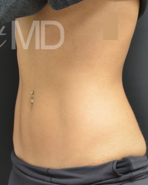 After Image: Abdomen - left-front-oblique