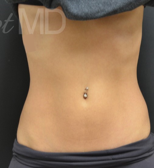 After Image: Abdomen - front