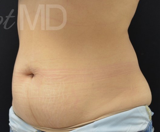 After Image: Abdomen - left-front-oblique