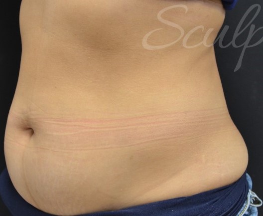 Before Image: Abdomen - left-front-oblique